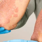 Innovative Psoriasis Treatments