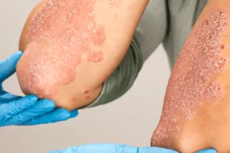 Innovative Psoriasis Treatments
