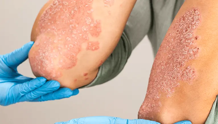 Innovative Psoriasis Treatments
