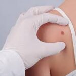 Mohs Surgery