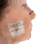 Mohs Surgery