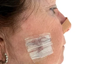 Mohs Surgery