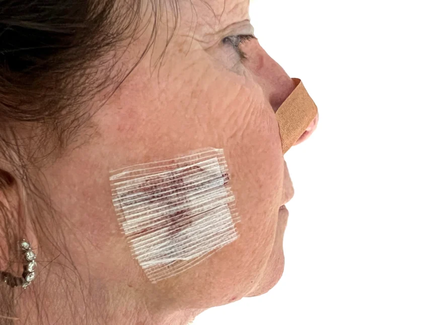 Mohs Surgery