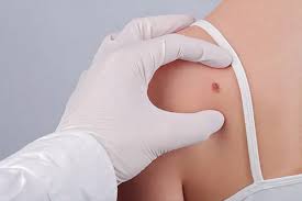 Mohs Surgery