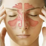 Signs of Sinusitis