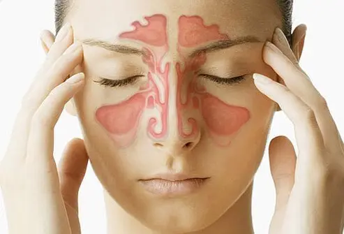 Signs of Sinusitis