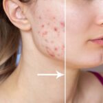 Treatments for Acne and Scarring