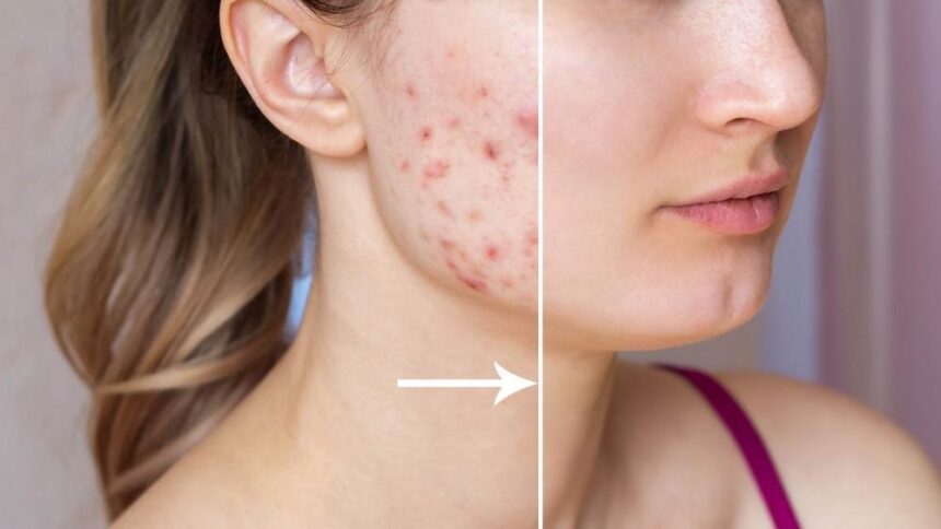 Treatments for Acne and Scarring