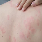 Triggering Hives