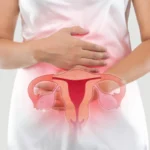 Link Between PCOS and Infertility