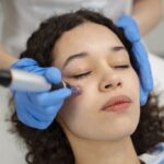 Benefits of Microneedling