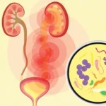 Risk Factors of UTIs