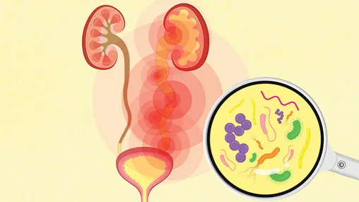 Risk Factors of UTIs
