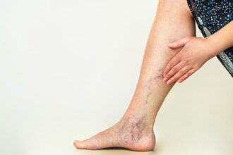 Treating Varicose Veins