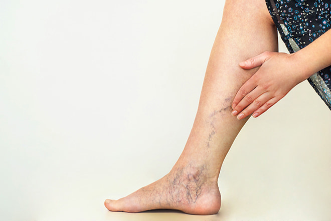 Treating Varicose Veins